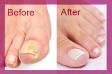 Nail Fungus Home Remedy - The Anti-Fungal Solution From Zeta Clear