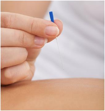 Acupuncture By Sigyta Hart