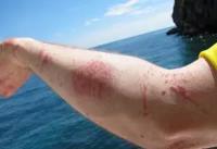 How To Treat A Jellyfish Sting?
