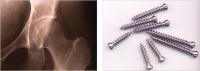 Titanium Bone Screws 