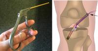 Case Study - The Suture Cutter