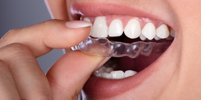Polyurethane Being Used for Teeth Aligners