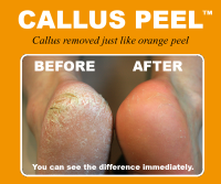 Callus Peel Foot Treatments