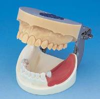 Implant Practice Jaw Model